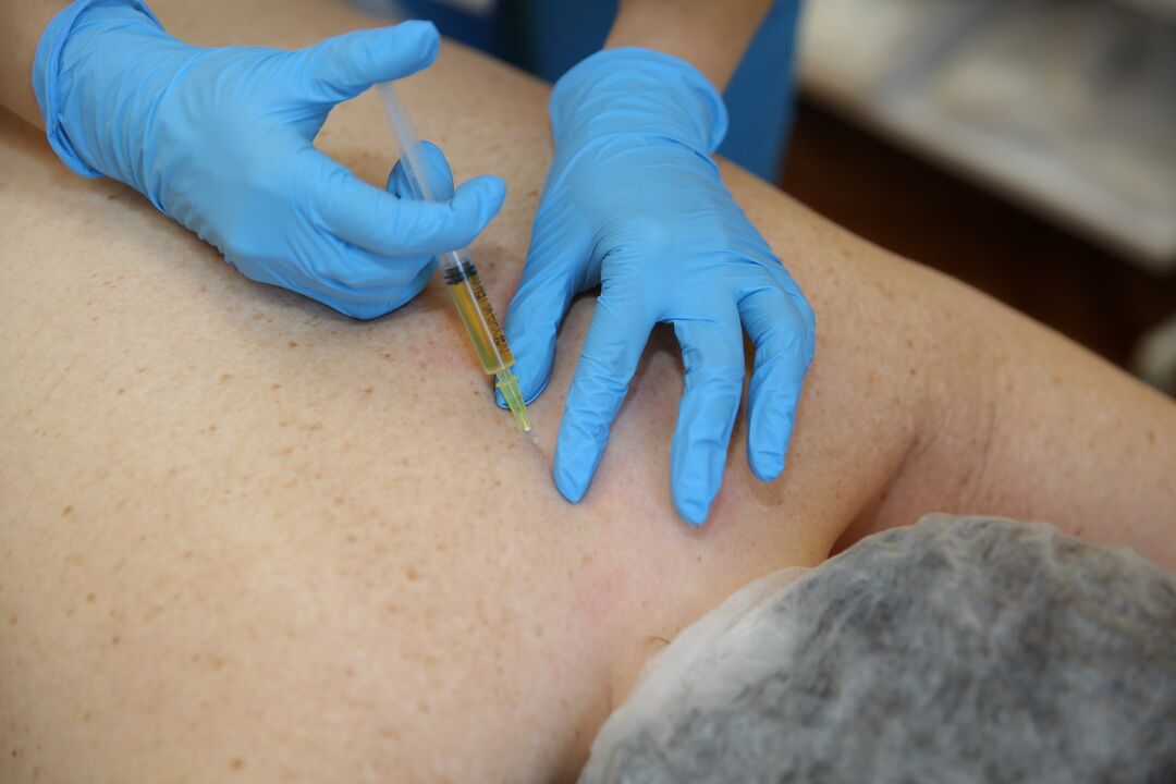 Injekcije hondroprotektorjev za hrbet