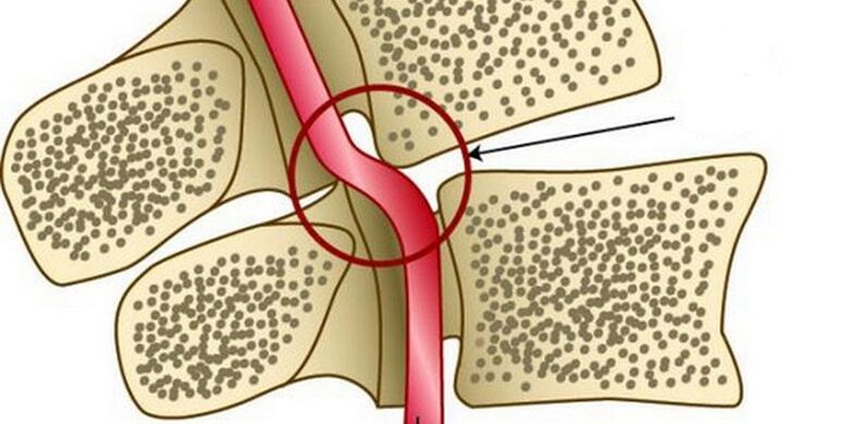 Deformacija vretenčne arterije zaradi nestabilnosti vretenc